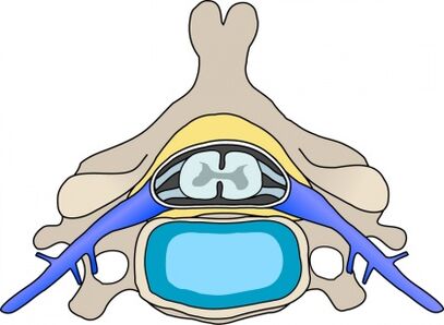 Protabio dans la vertèbre avec une ostéochondose cervicale