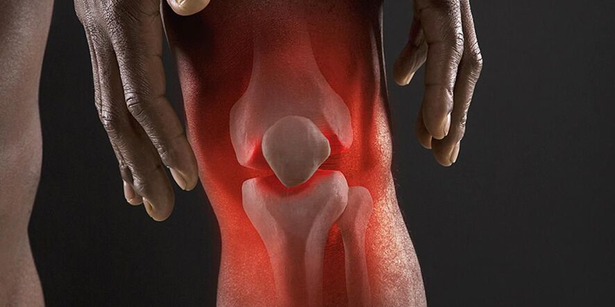 Une sensation de brûlure au niveau du genou est un symptôme de gonarthrose